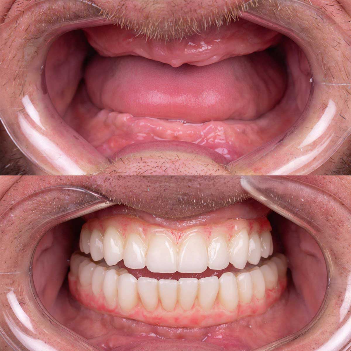 3D illustration of All-on-4 dental implant system supporting a full fixed bridge in Los Algodones.