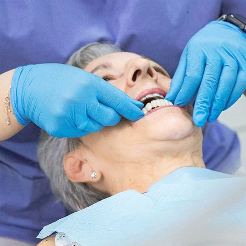 Full arch All-on-6 dental implant restoration diagram showing superior stability for patients with bone loss.