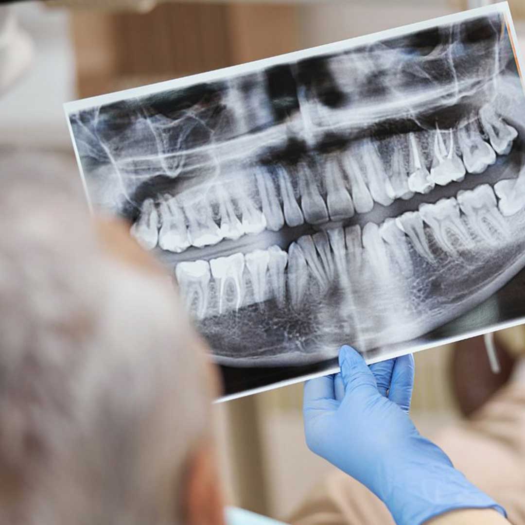 3D medical diagram of a sinus lift and bone graft procedure preparing the jaw for dental implants.
