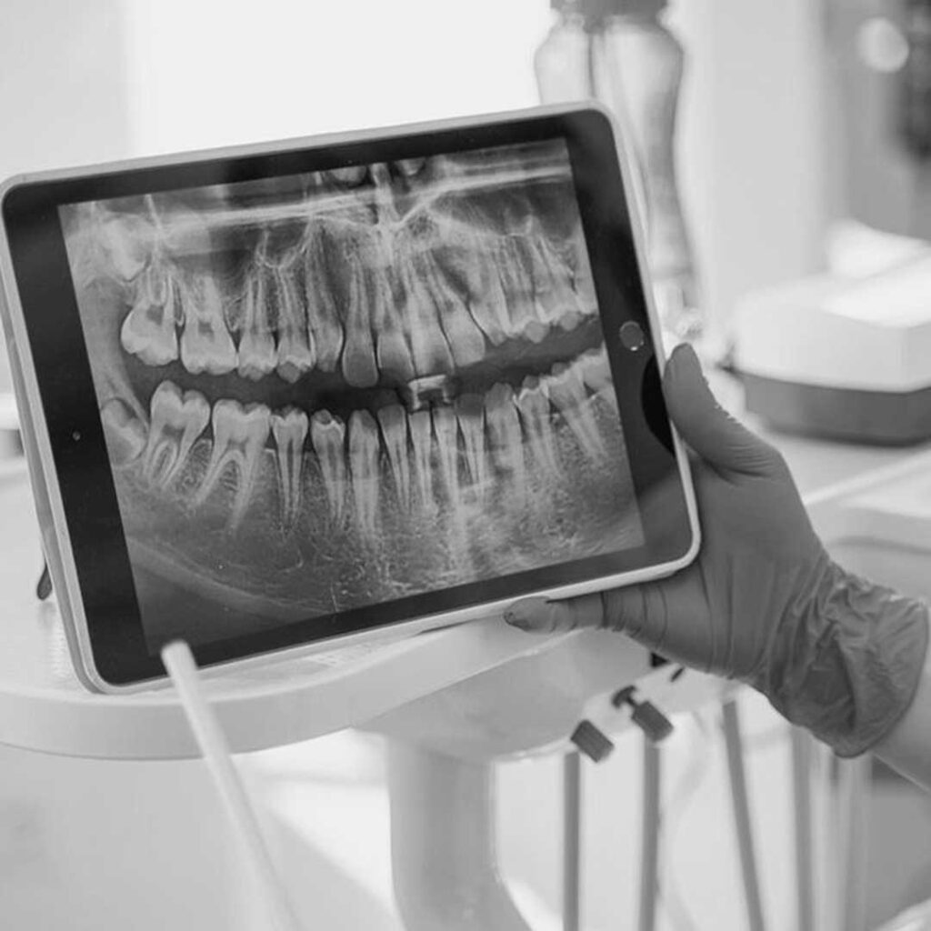 3D medical diagram of a sinus lift and bone graft procedure preparing the jaw for dental implants.
