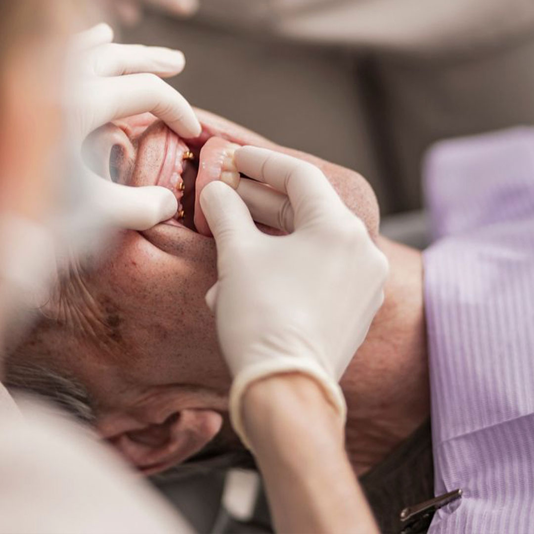 A calendar showing the 5-day stay timeline for All-on-4 dental implants in Los Algodones, Mexico.