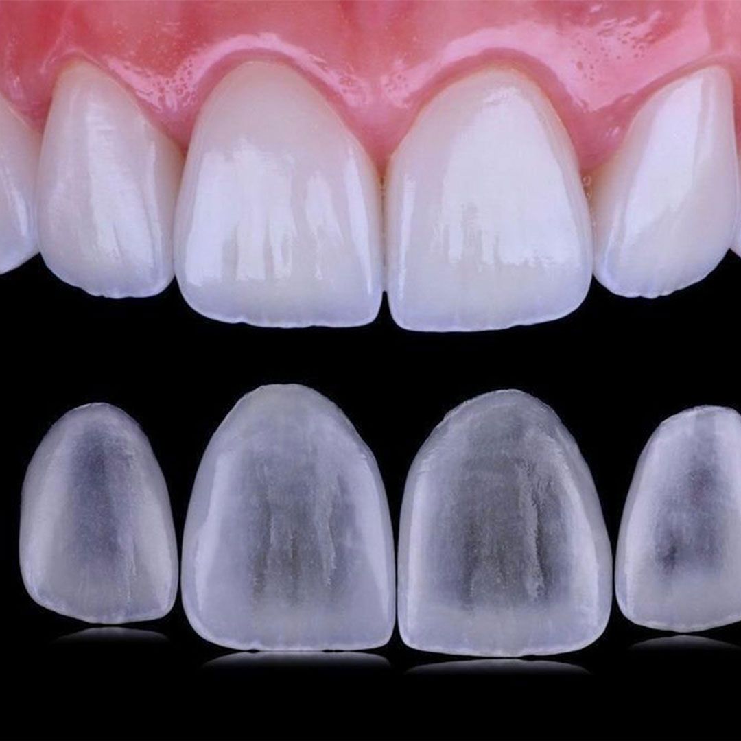 Before and after results of porcelain dental veneers in Los Algodones Mexico, showing a total smile transformation.