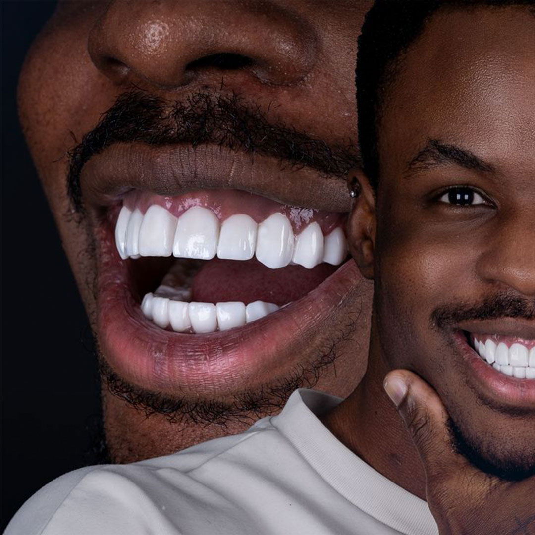 Same-day porcelain ceramic crown procedure in Los Algodones Mexico using CAD/CAM digital technology.