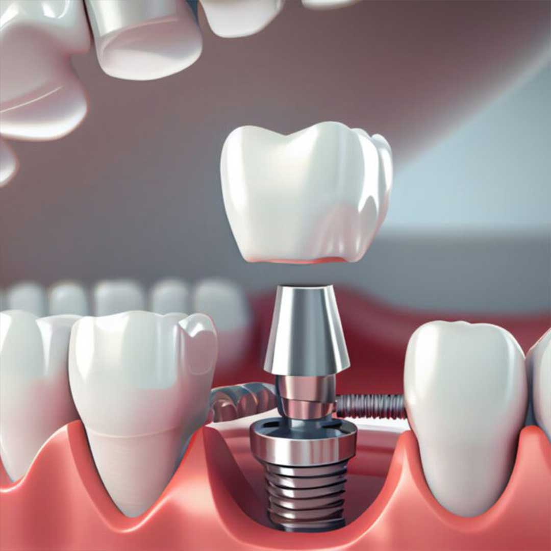 A comparison of tooth replacement options in Los Algodones Mexico, including dental implants and bridges.